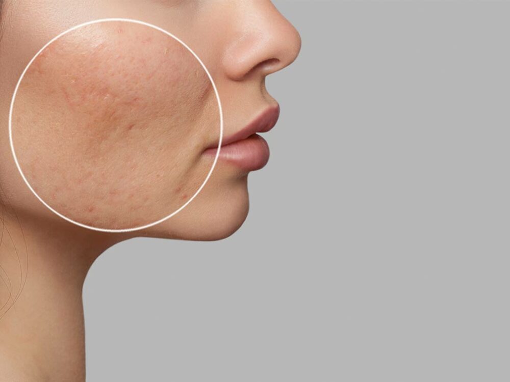 Akne im Gesicht behandeln lassen