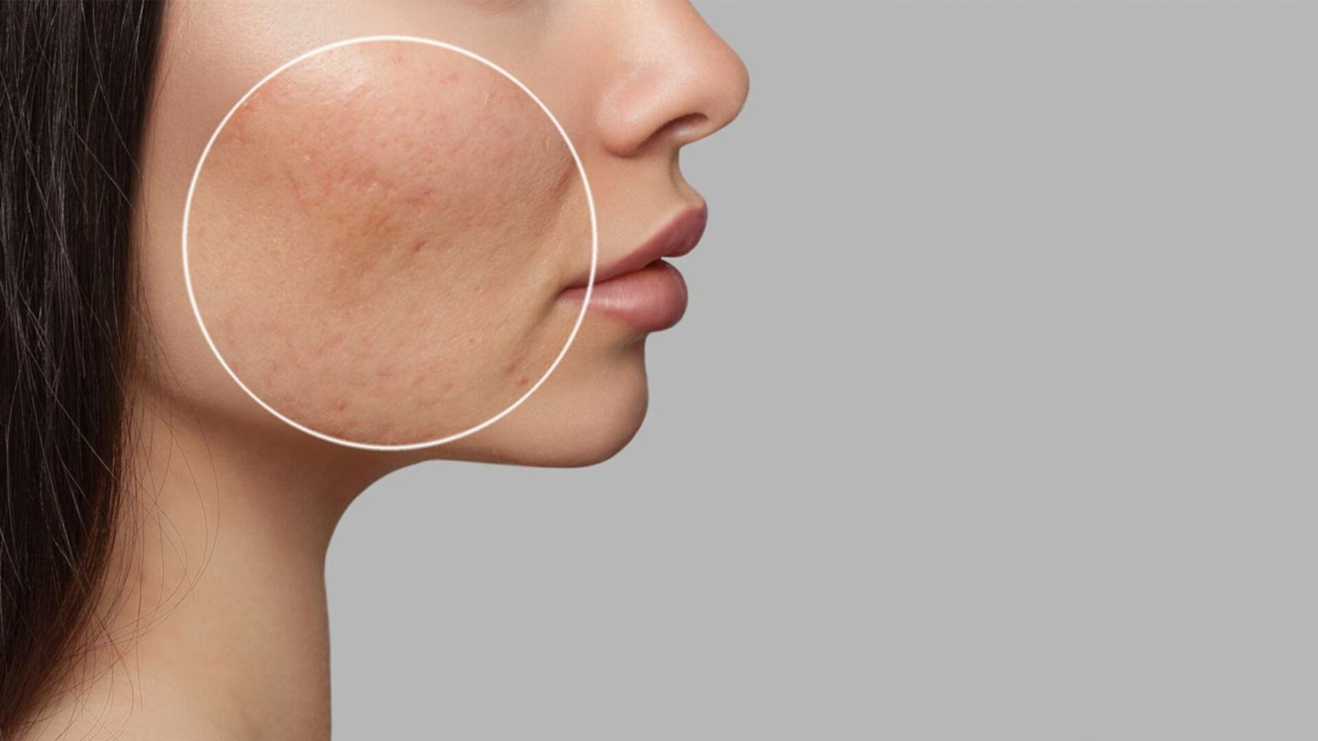 Akne im Gesicht behandeln lassen