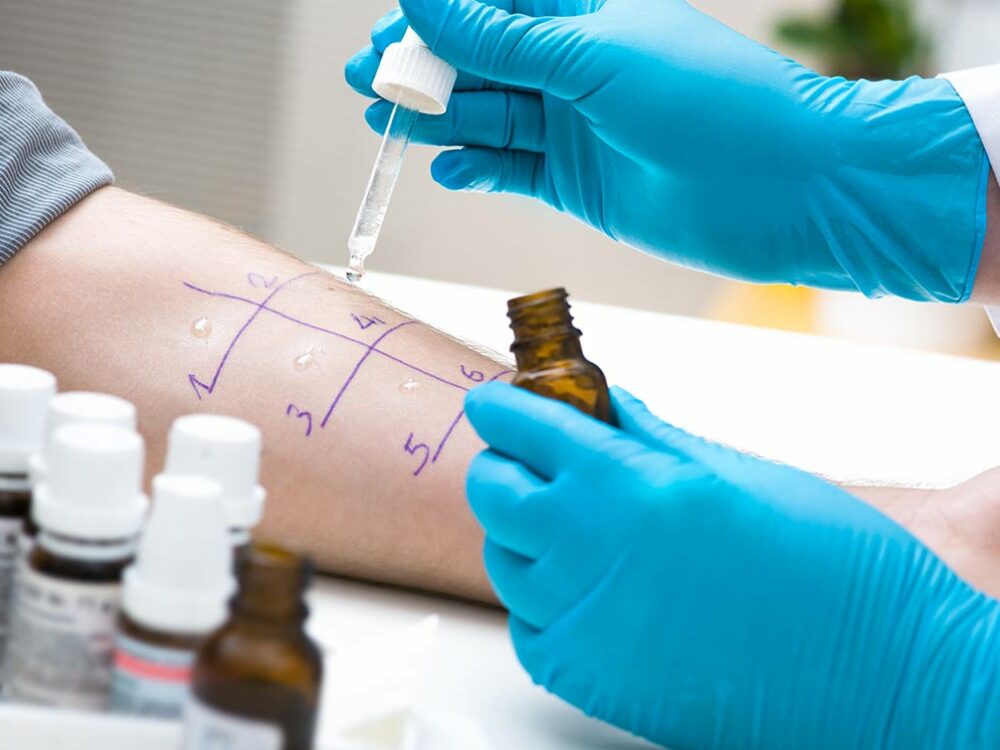 Allergietest auf der Haut