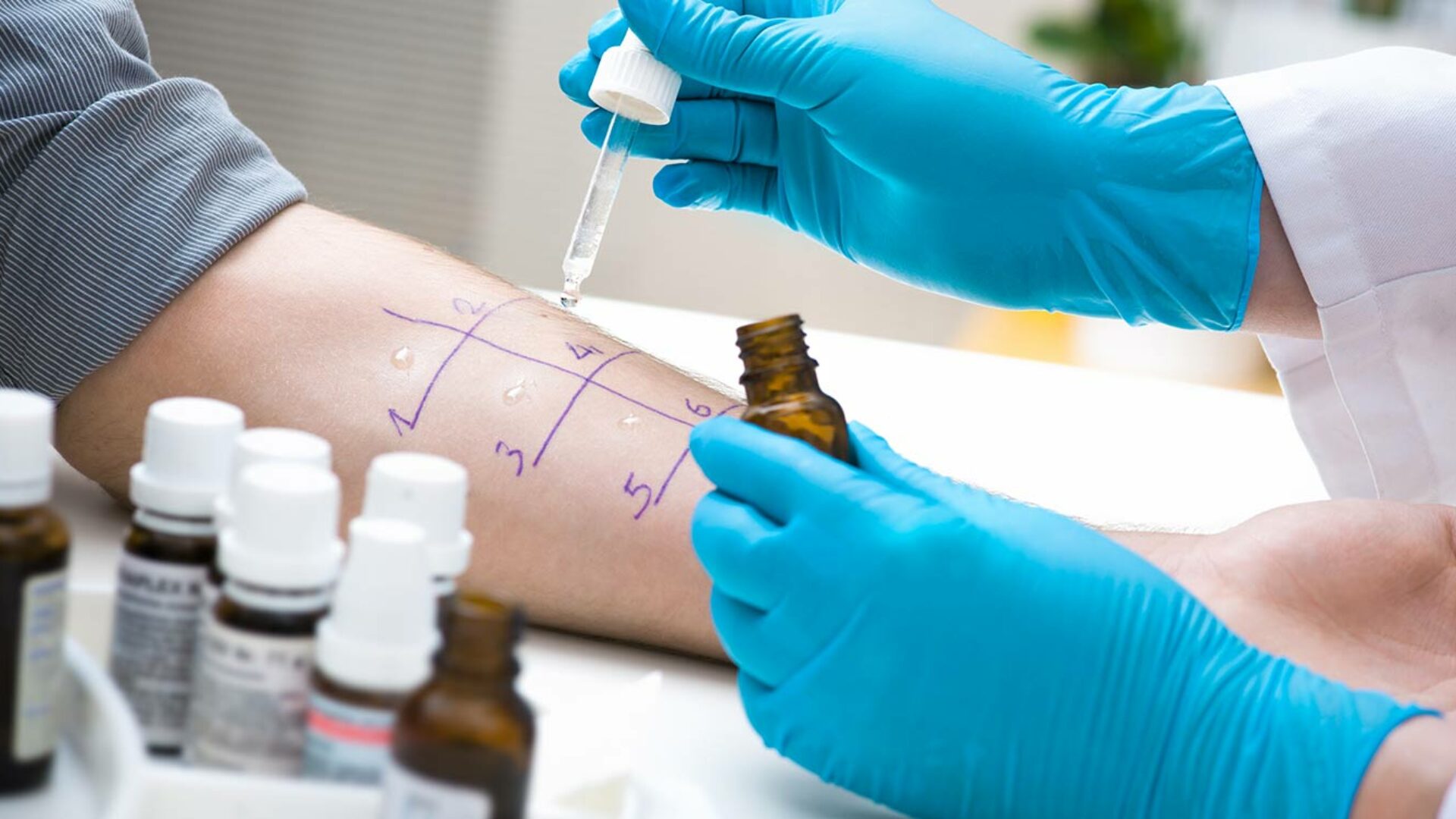 Allergietest auf der Haut