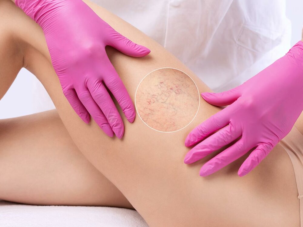 Besenreiser am Bein entfernen lassen