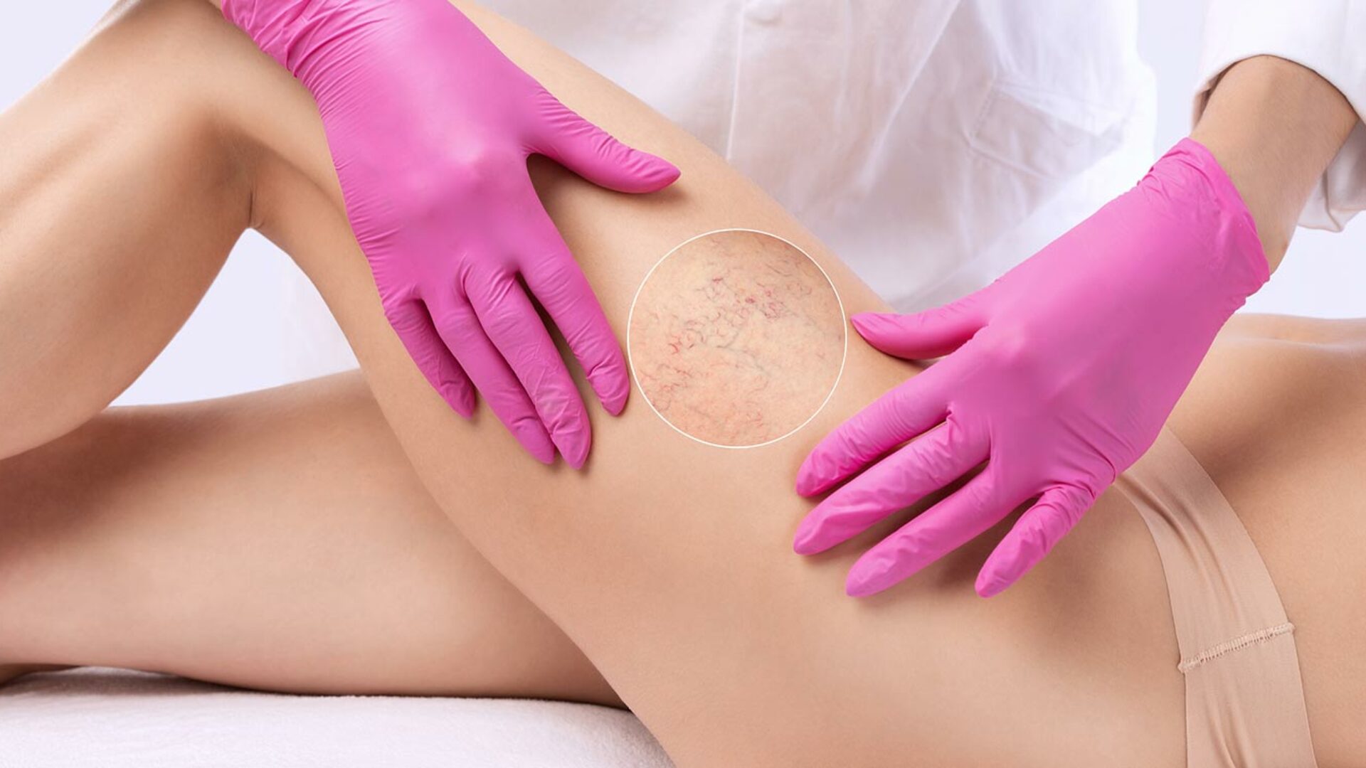 Besenreiser am Bein entfernen lassen