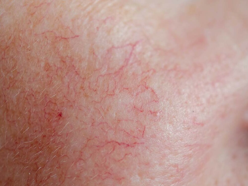 Couperose und Rosacea auf der Wange