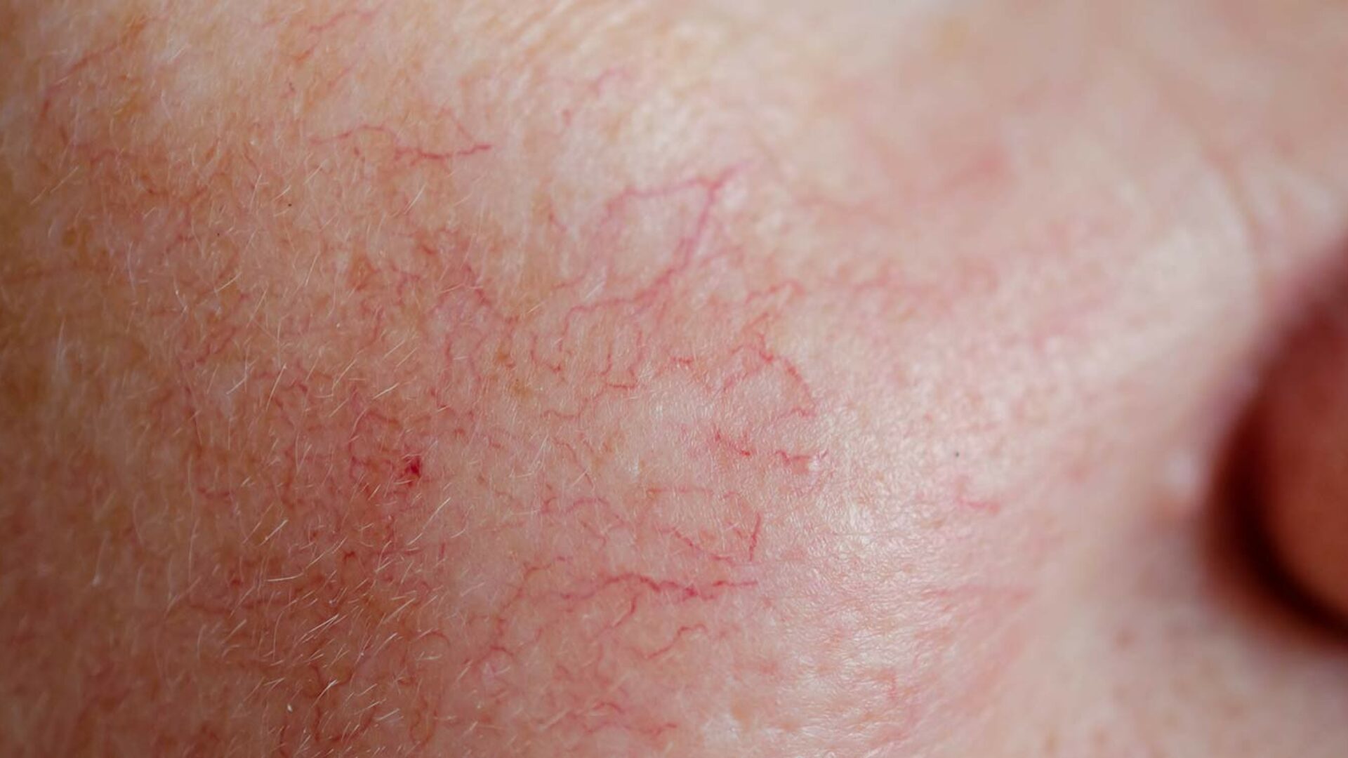Couperose und Rosacea auf der Wange
