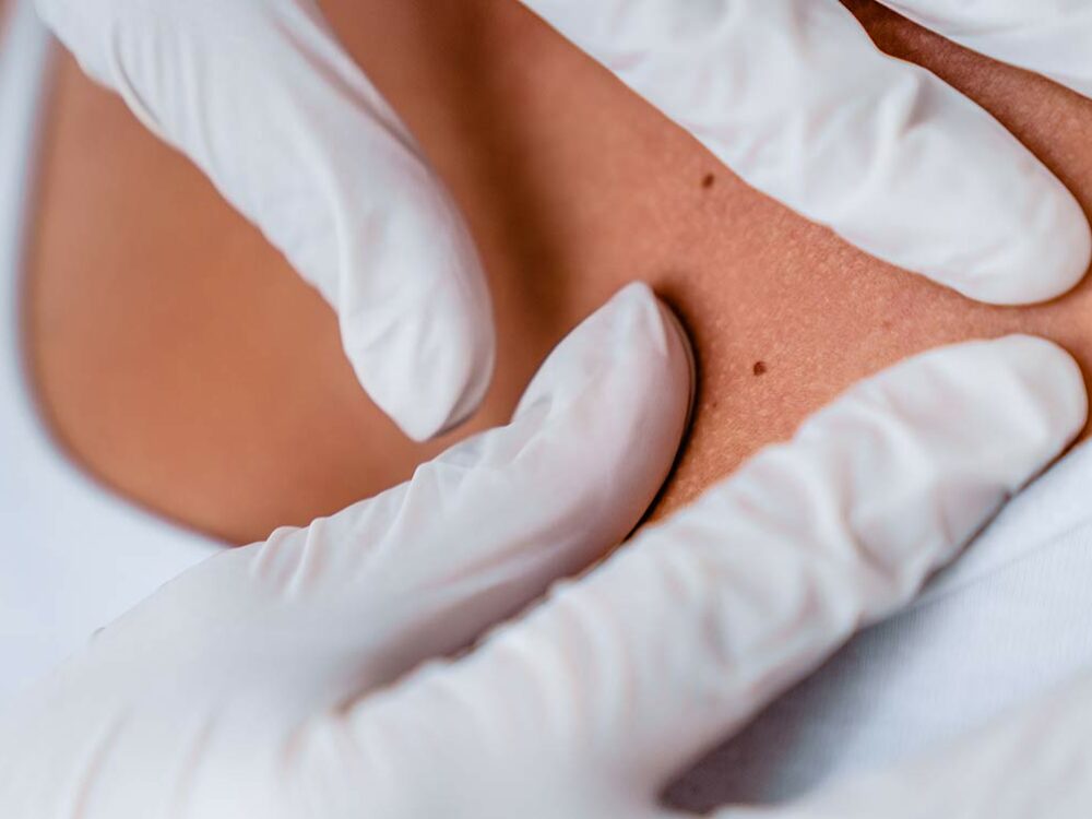 Elektrochemotherapie in Bonn