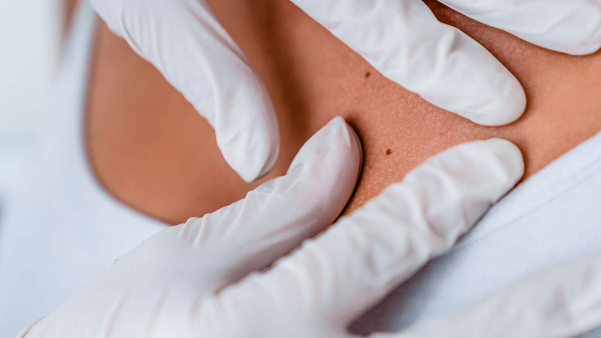 Elektrochemotherapie zur Behandlung von Hautkrebs