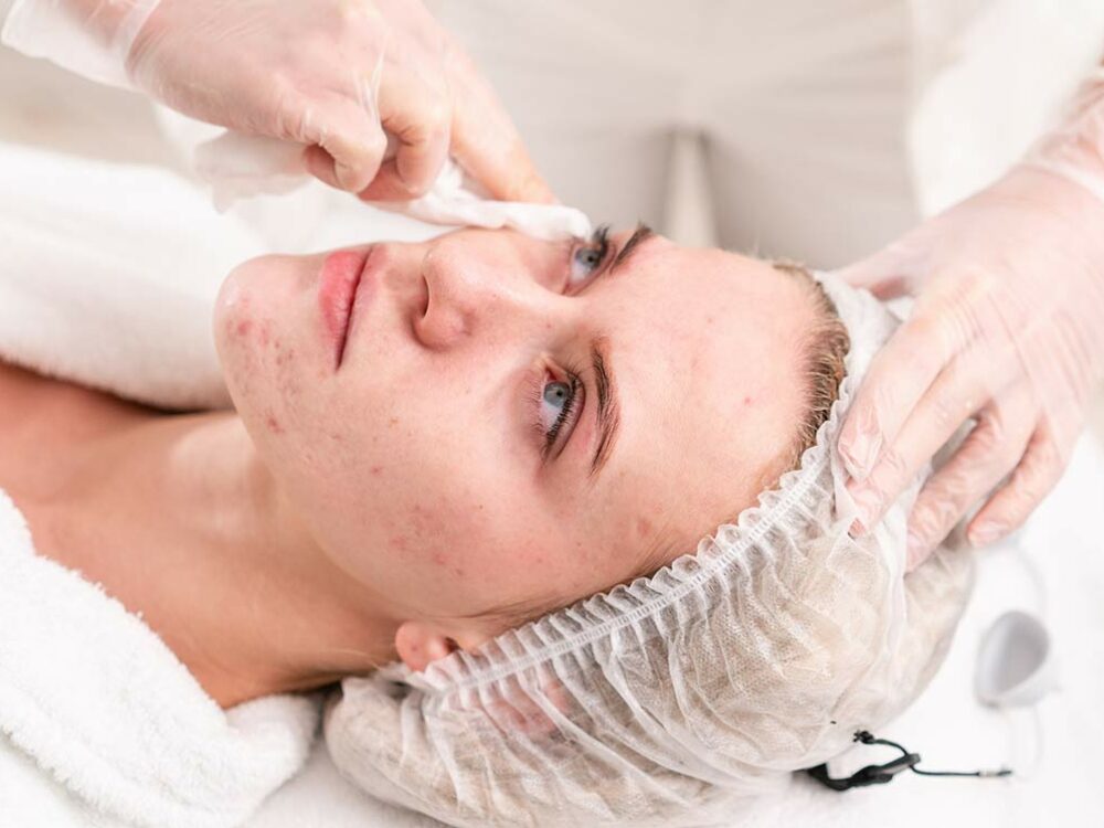 Auftragen eines Fruchtsäurepeelings auf der Haut