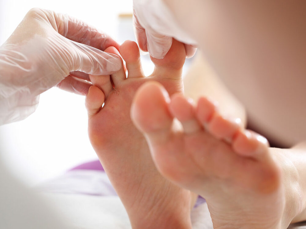 Nagelpilz und Fußpilz behandeln lassen