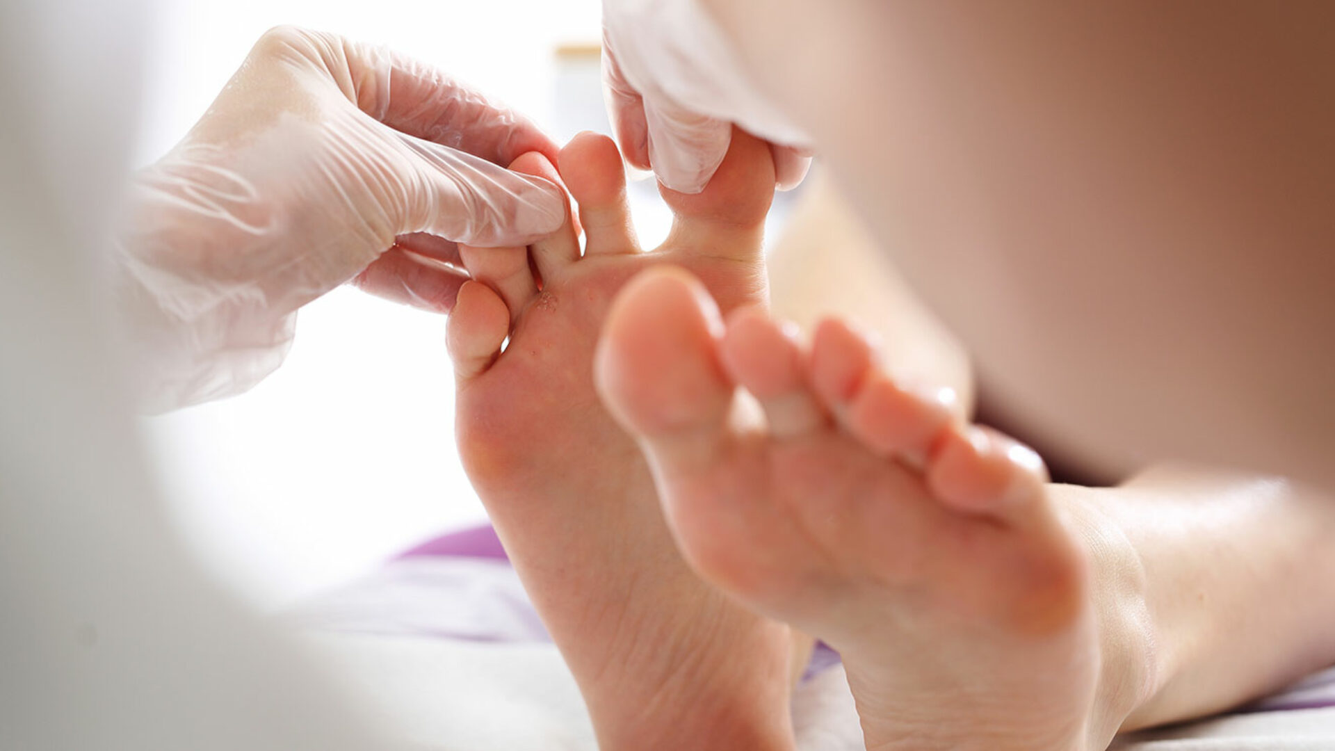 Nagelpilz und Fußpilz behandeln lassen