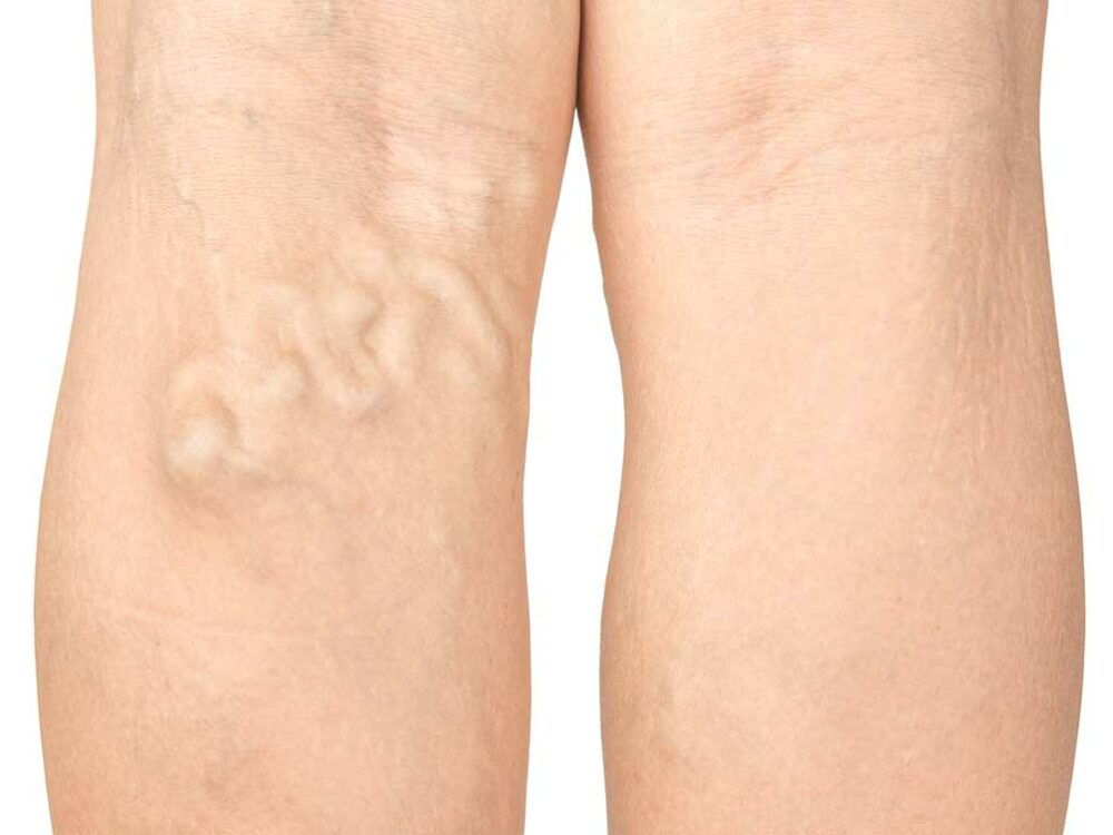 Krampfadern vom Hautarzt behandeln