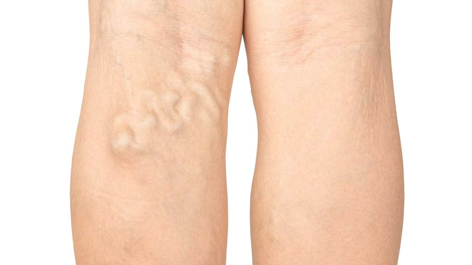 Krampfadern vom Hautarzt behandeln