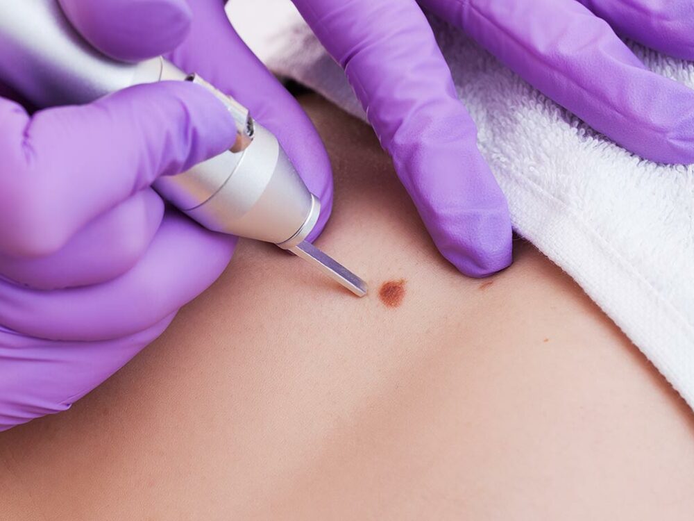 Muttermale entfernen lassen bei einem Hautarzt
