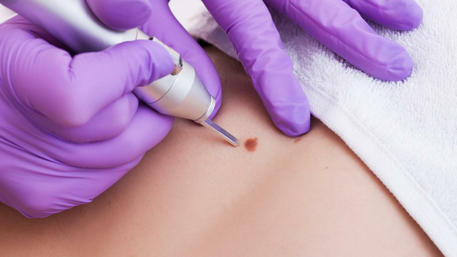 Muttermale entfernen lassen bei einem Hautarzt
