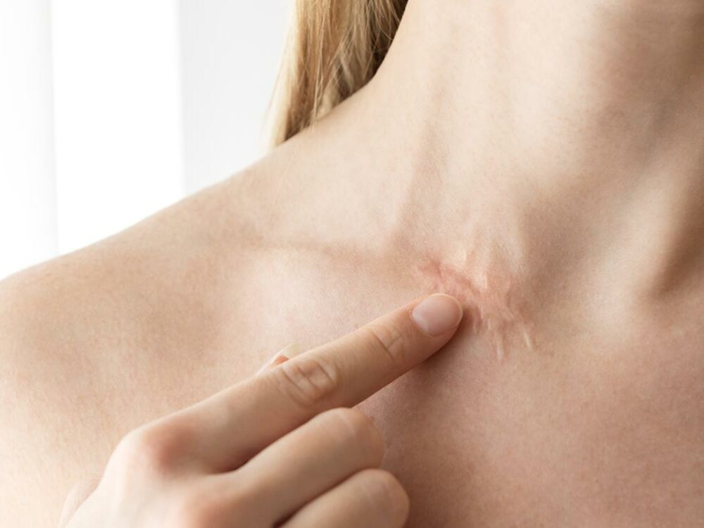 Narben entfernen lassen