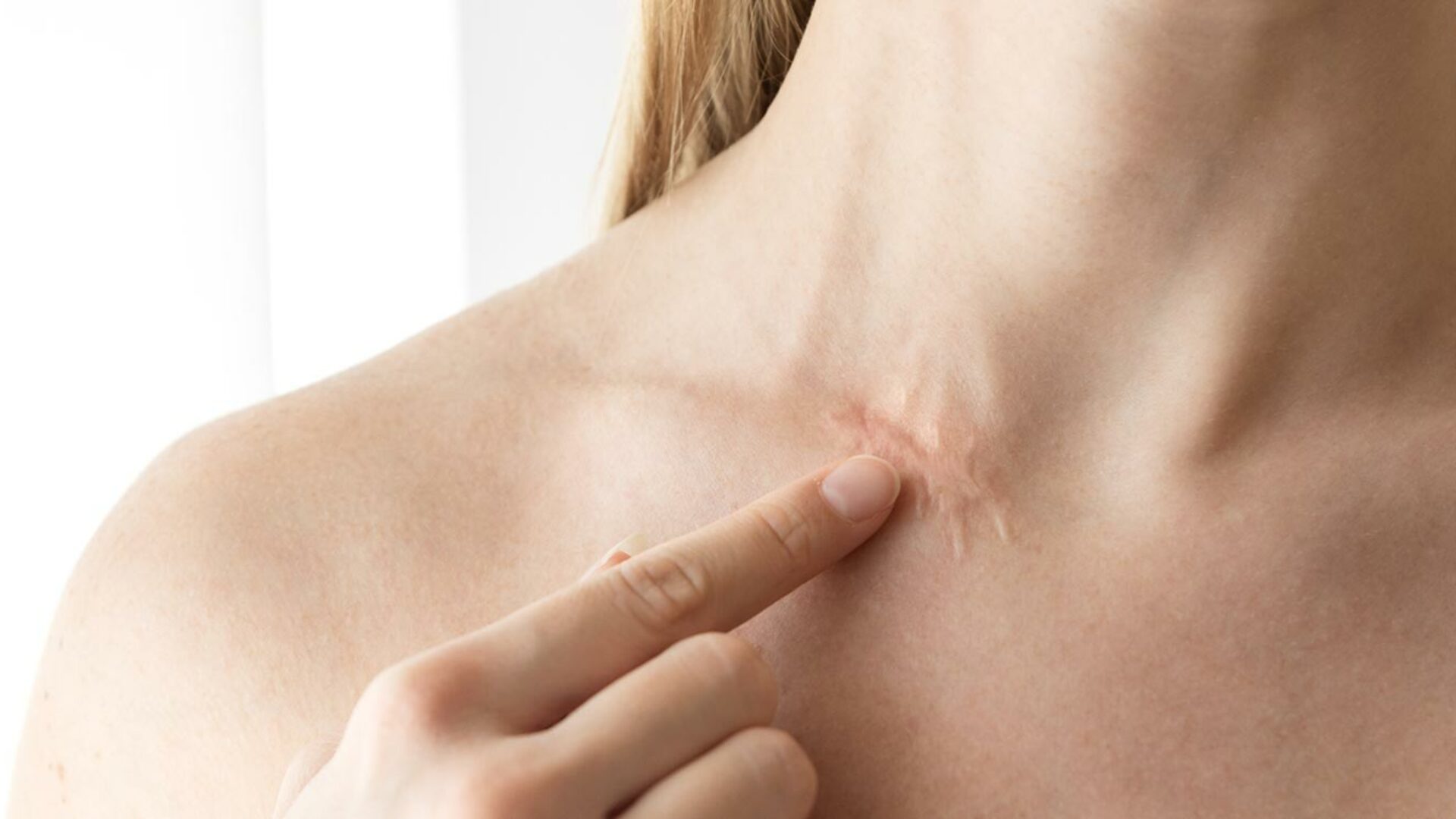 Narben entfernen lassen