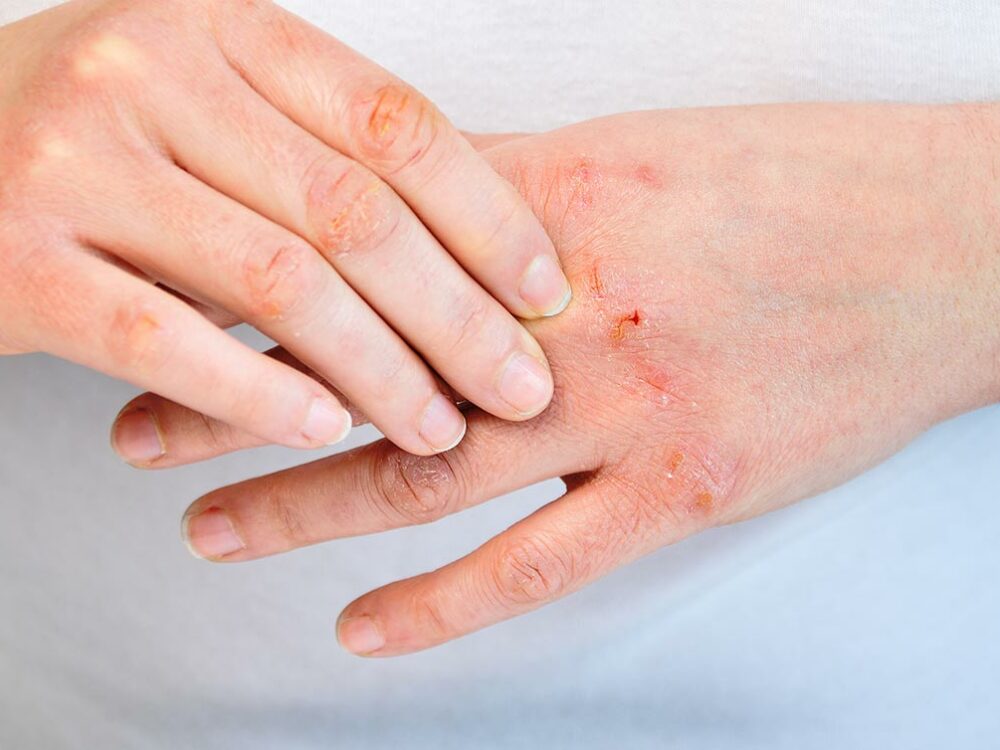 Neurodermitis und Ekzeme behandeln bei einem Hautarzt in Bonn