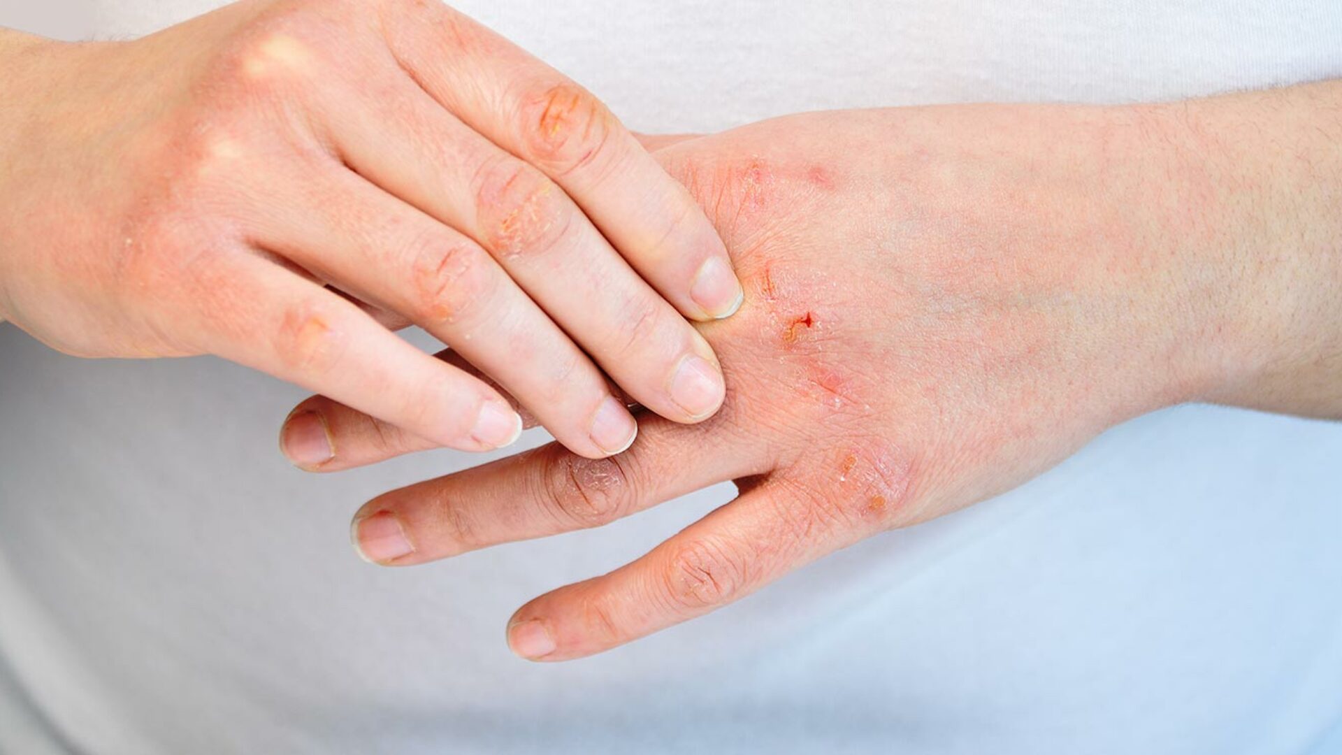 Neurodermitis und Ekzeme behandeln bei einem Hautarzt in Bonn