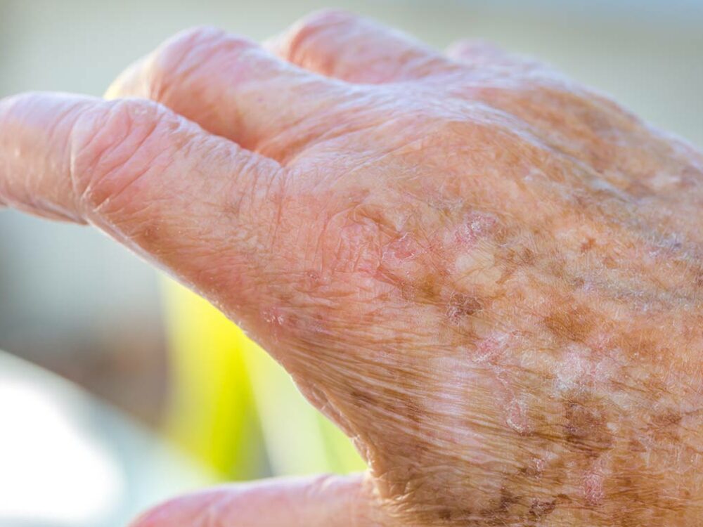 Pigmentflecken und Altersflecken auf der Hand