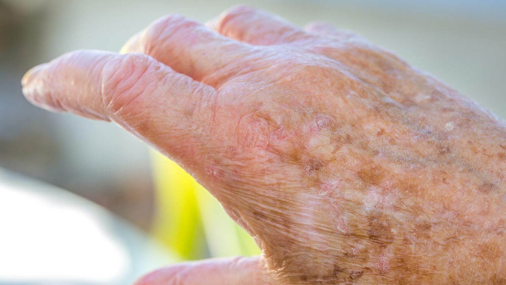 Pigmentflecken und Altersflecken auf der Hand