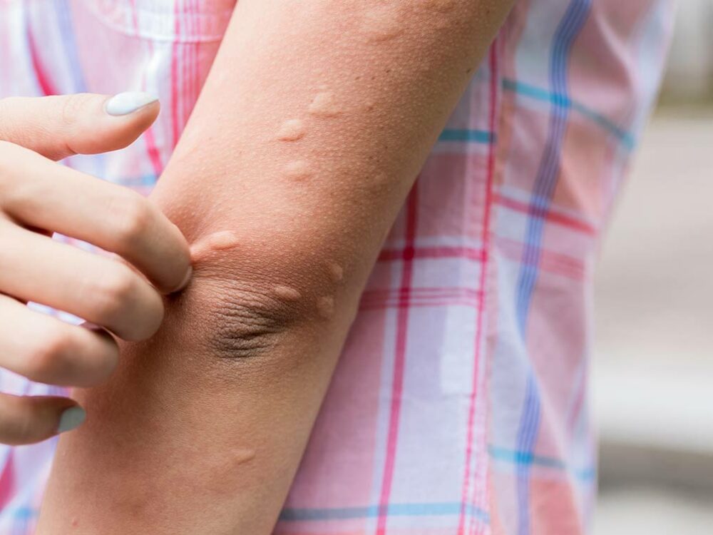 Tropendermatologie und Reisedermatologie in Bonn