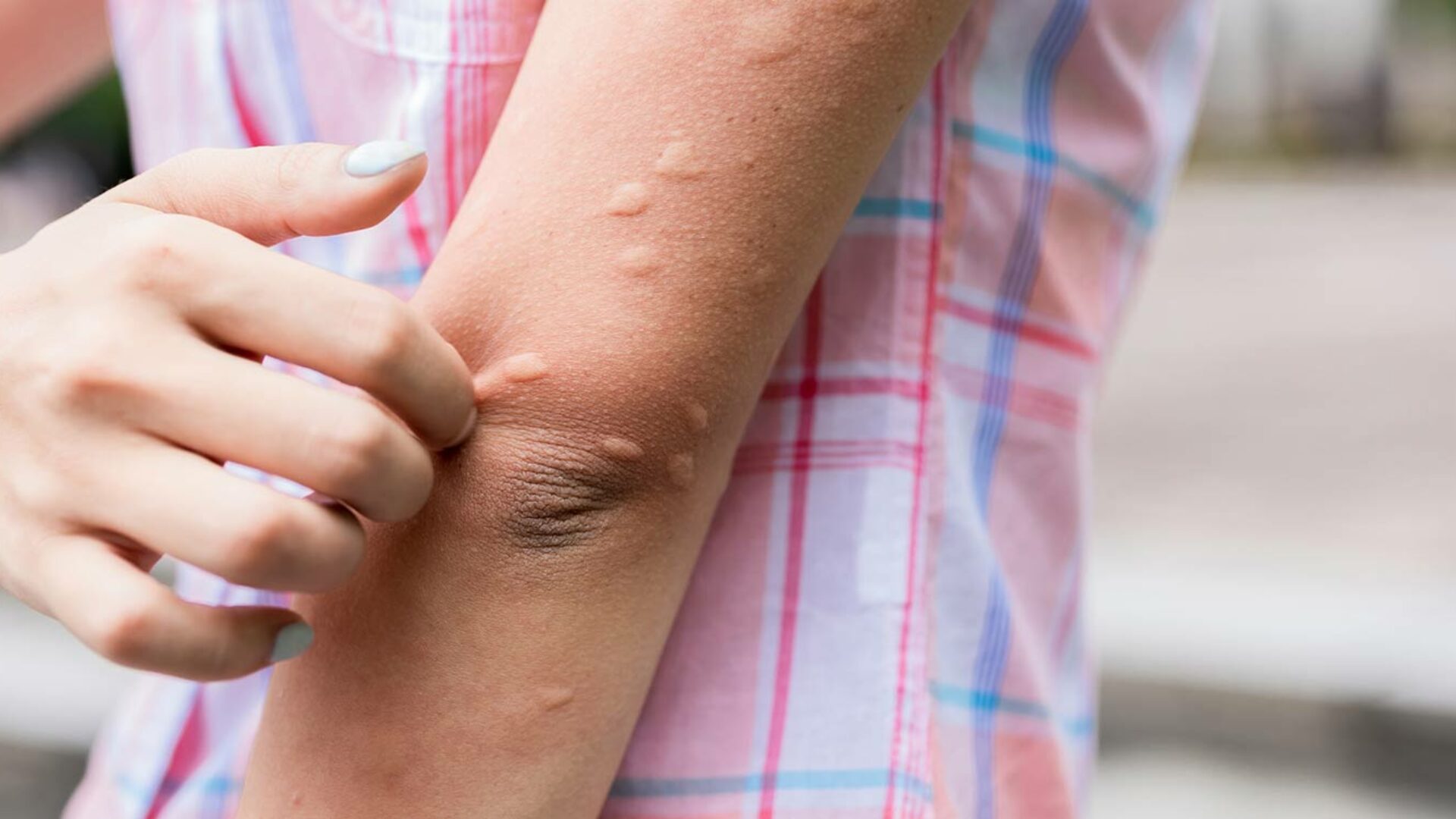 Tropendermatologie und Reisedermatologie in Bonn