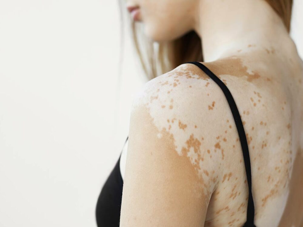 Vitiligo (Weißfleckenkrankheit) behandeln lassen