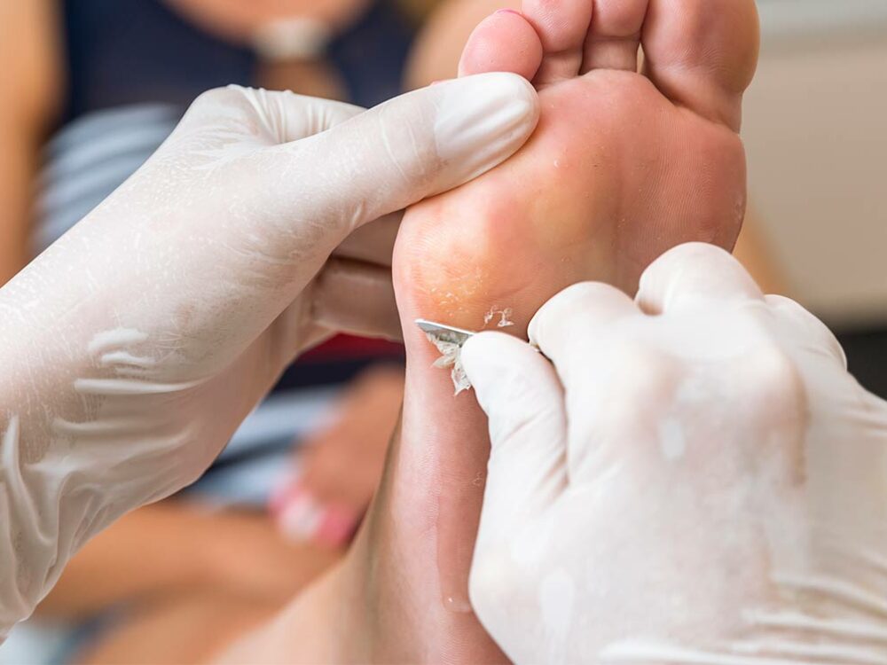 Entfernung von Warzen am Fuß