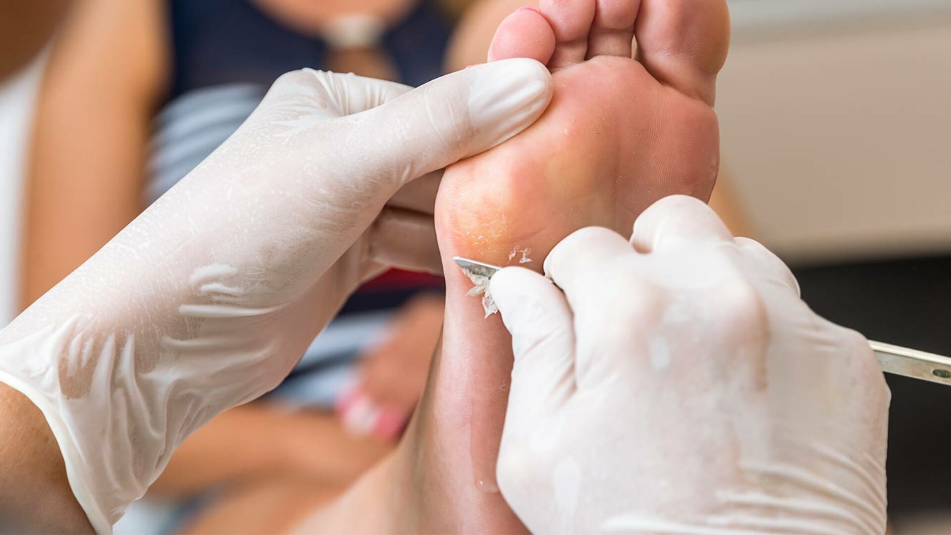 Entfernung von Warzen am Fuß