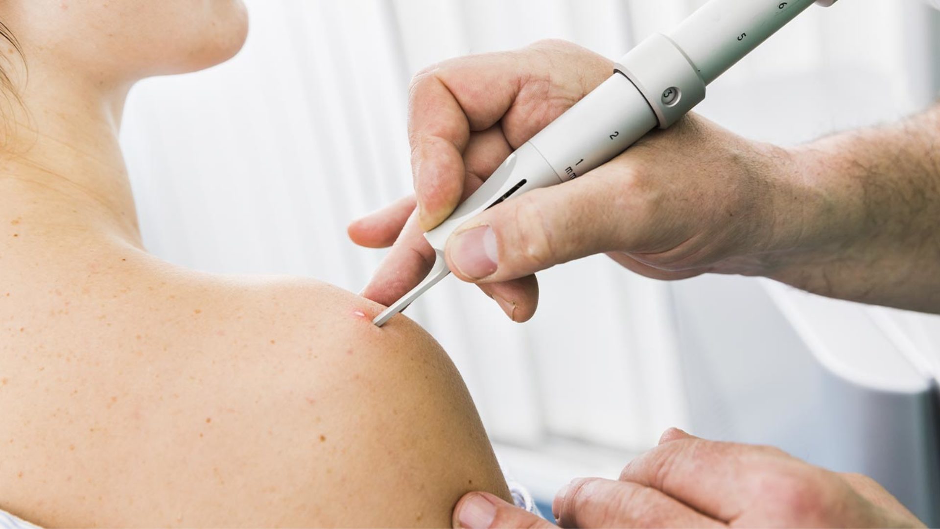 Entfernung mittels modernem Laser