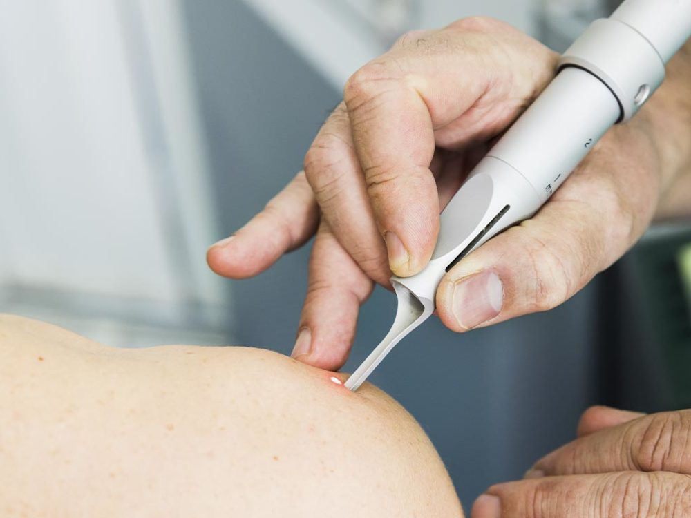 Entfernung mittels Laser